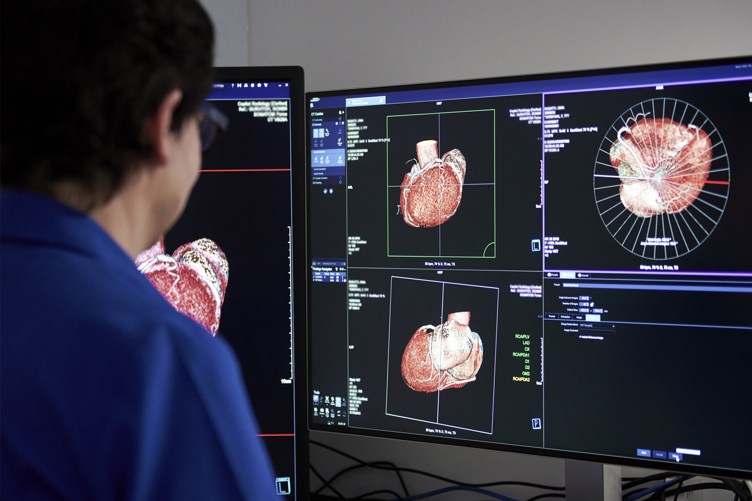 CT Colonography Results Shown on Computer Screen | CT Colonography | FMIG