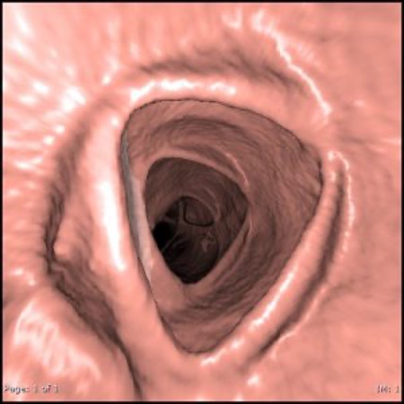 CT Virtual Colonography view | CT Colonography | FMIG