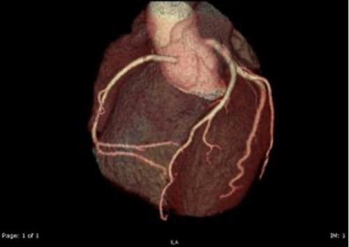 Coronary Arteries View Through CT Coronary Angiography | CTCA | FMIG
